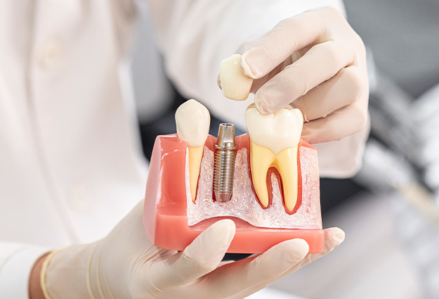 DENTIST|임플란트 노하우