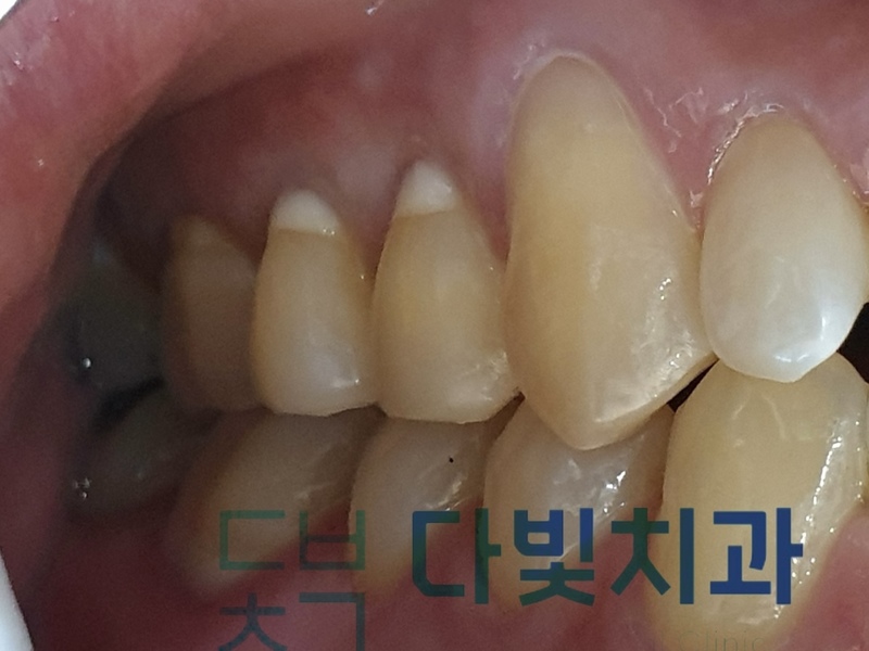 치경부마모