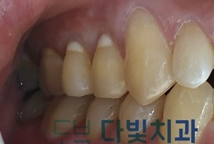 치경부마모