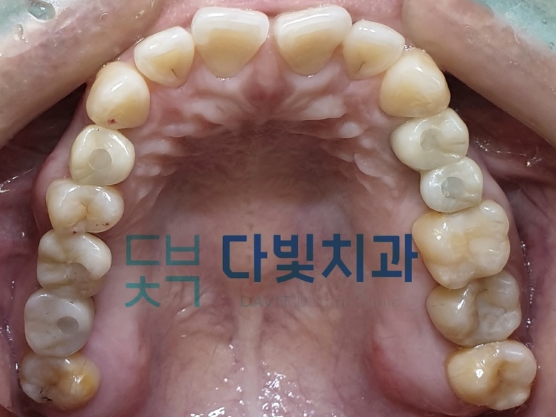 가이드 무절개 임플란트