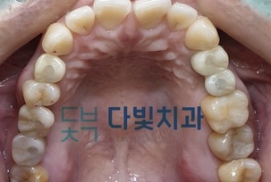 가이드 무절개 임플란트