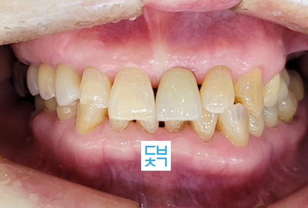 앞니 발치후 즉시 임플란트
