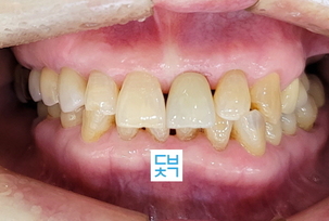 앞니 발치후 즉시 임플란트