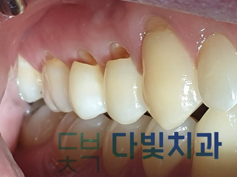 치경부마모
