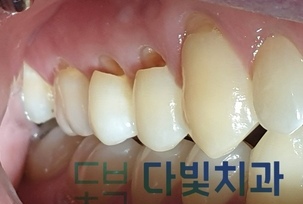 치경부마모