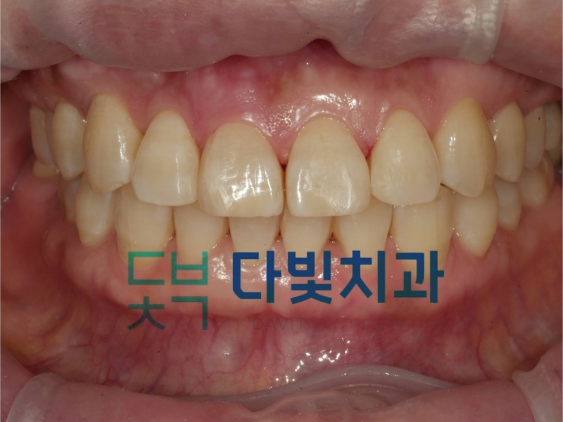 앞니 틈 메우기