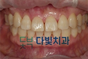 앞니 틈 메우기
