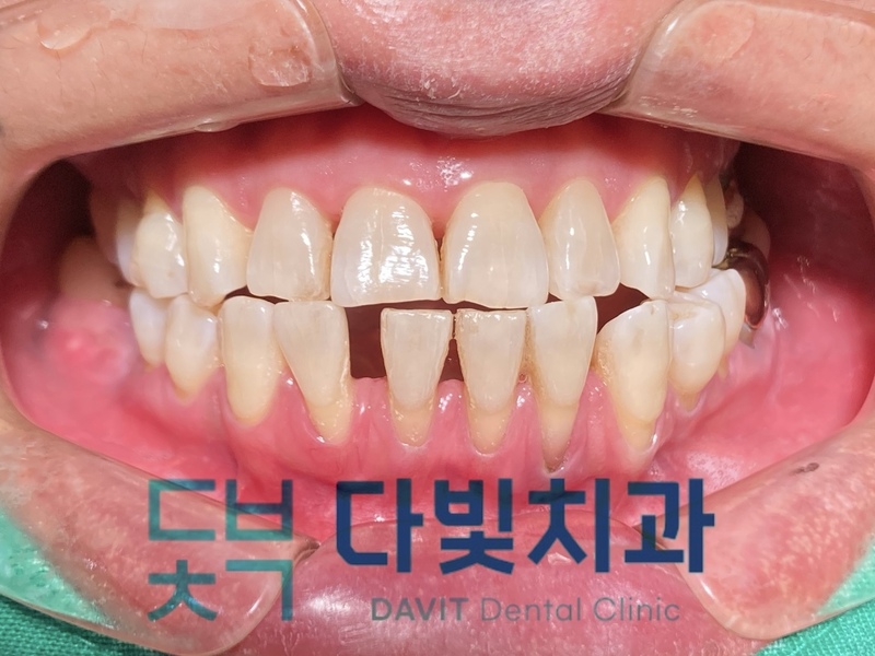 세라핀 투명 교정 중