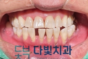세라핀 투명 교정 중