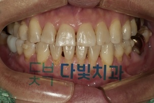 세라핀 투명 교정 중