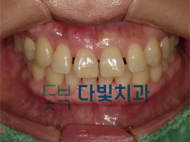 앞니 틈 메우기