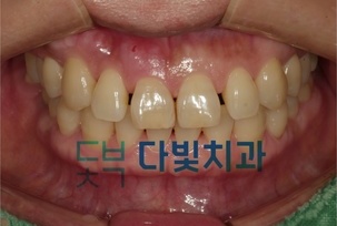 앞니 틈 메우기
