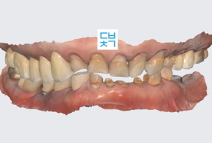 앞니 임플란트